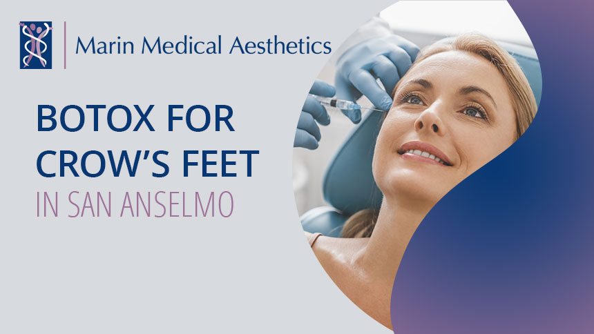 Botox for crows feet in San Anselmo