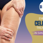 Emtone Cellulite Treatment in San Anselmo