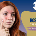 Rosacea Treatment in San Anselmo