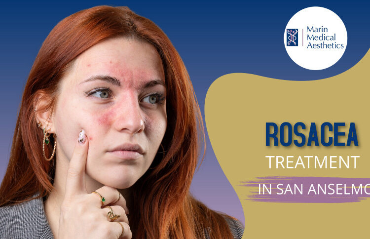 Rosacea Treatment in San Anselmo