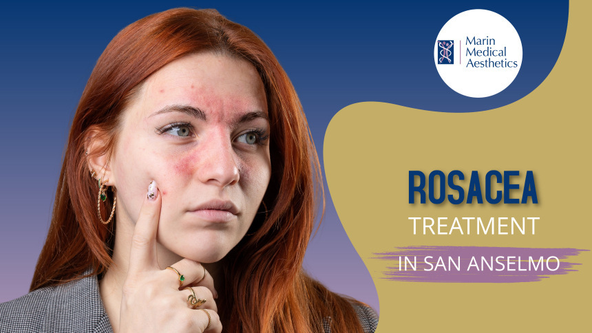 Rosacea Treatment in San Anselmo